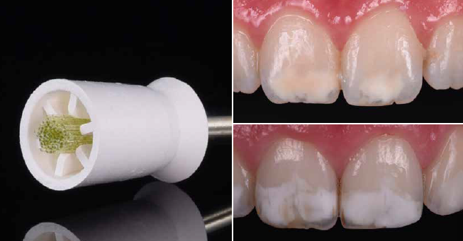 Icon Vestibular: Comparing Different Abrasive Methods for the Infiltration Technique